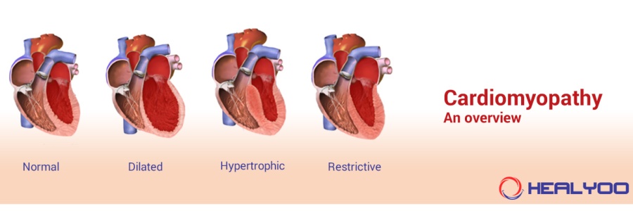 cardiomyopathy: An overview